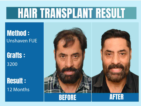 Why You Might Lose Hair After Hair Transplant Surgery in Delhi